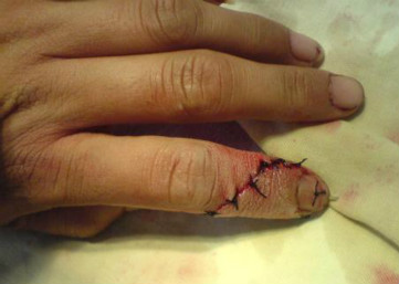 断指再植的饮食注意事项.jpg 断指再植的饮食注意事项.jpg