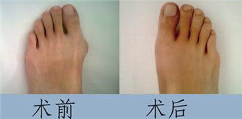 拇外翻2.jpg 拇外翻2.jpg