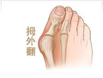 拇外翻3.jpg 拇外翻3.jpg