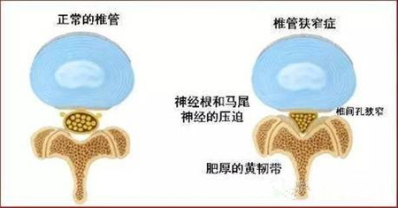 腰杆狭窄.jpg 腰杆狭窄.jpg