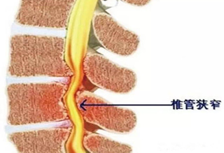 腰部 脊柱 管 狭窄 症 看護