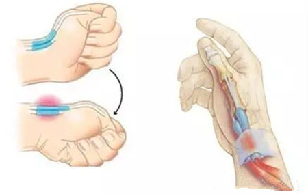 手腕腱鞘炎症状_副本.jpg 手腕腱鞘炎症状_副本.jpg