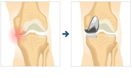 膝关节置换.jpg
