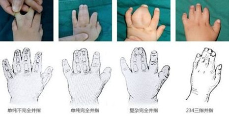 小儿并指畸形1.jpg 小儿并指畸形1.jpg