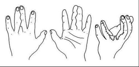 小儿并指畸形.jpg 小儿并指畸形.jpg