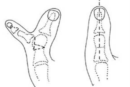 手术.jpg 手术.jpg