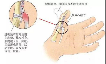 大拇指腱鞘炎.jpg 大拇指腱鞘炎.jpg