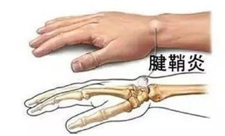 腱鞘炎222.jpg 腱鞘炎222.jpg