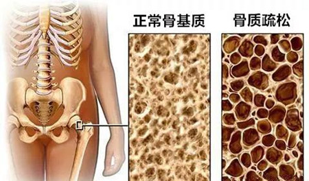 骨质疏松.jpg 骨质疏松.jpg
