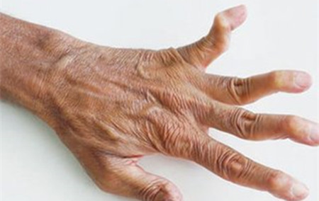 类风湿.jpg 类风湿.jpg