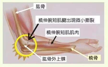 网球肘111.jpg 网球肘111.jpg