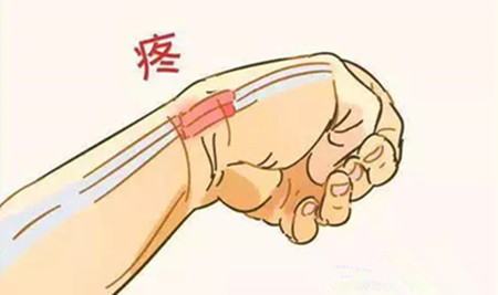 腱鞘炎.jpg 腱鞘炎.jpg