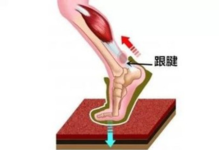 跟腱炎.jpg 跟腱炎.jpg