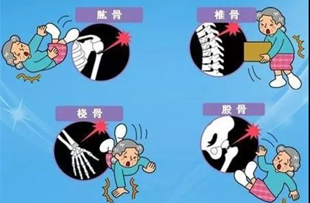 骨质疏松骨折.jpg 骨质疏松骨折.jpg