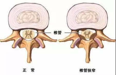 颈椎椎管狭窄症状.jpg 颈椎椎管狭窄症状.jpg