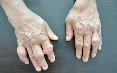 类风湿.jpg 类风湿.jpg