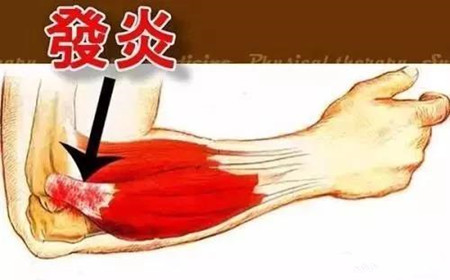 网球肘.jpg 网球肘.jpg