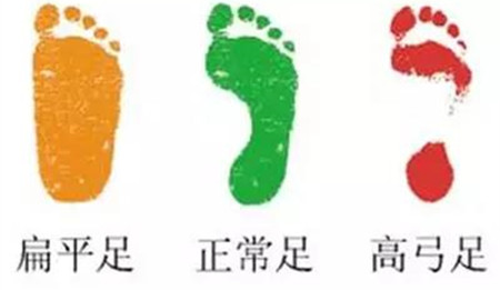 扁平足判断.jpg