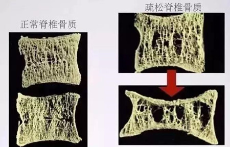 骨质疏松.jpg 骨质疏松.jpg