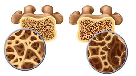 骨质疏松1.jpg
